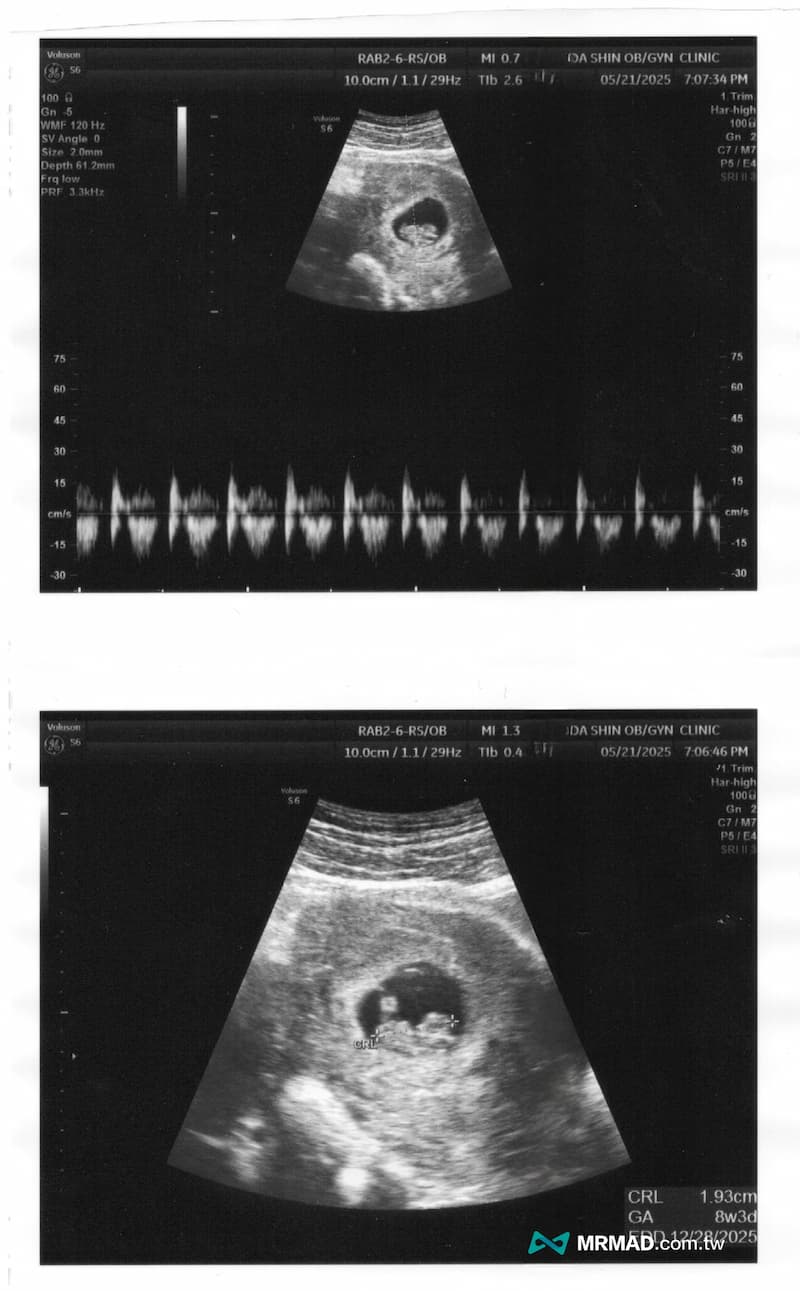 懷孕最大魔王關卡第一次聽見寶寶心跳